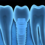 インプラントの特徴