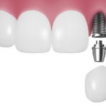 インプラントの治療方法