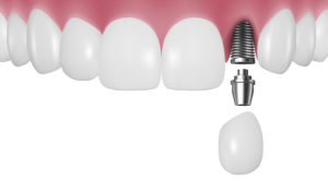 インプラントの治療方法