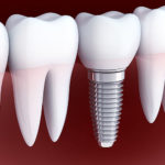 金属アレルギーの人はインプラントを受けられるの？