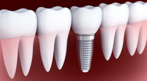 金属アレルギーの人はインプラントを受けられるの？