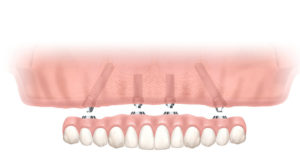 ほとんど歯がない方に「オールオン4」とは