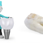 自分の歯とインプラントの違い
