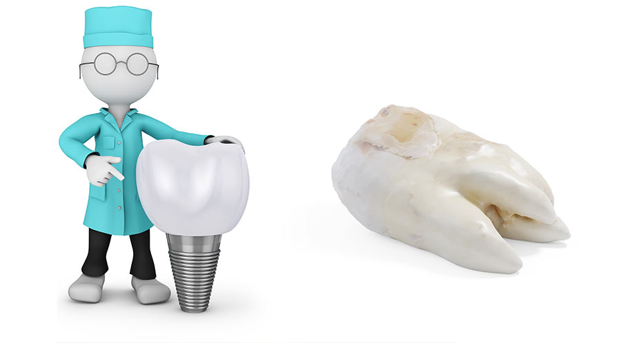 自分の歯とインプラントの違い