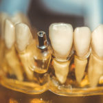 インプラントはいつ頃から始まったのか