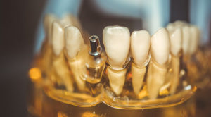 インプラントはいつ頃から始まったのか