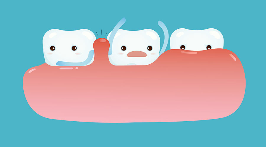 歯を失う歯周病