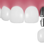 インプラントはどんな人でもうけれるのか