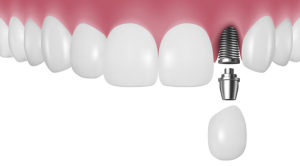 インプラントはどんな人でもうけれるのか