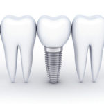 インプラント治療とは