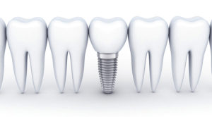 インプラント治療とは