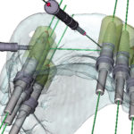 コンピュータによるインプラント治療（低侵襲治療）　