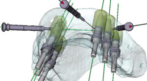 コンピュータによるインプラント治療（低侵襲治療）　