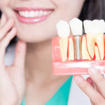 インプラントと差し歯はどちらがいい？