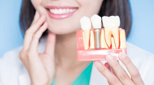 インプラントと差し歯はどちらがいい？