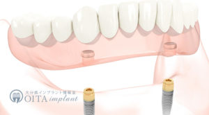 オーバーデンチャー（インプラント併用義歯）
