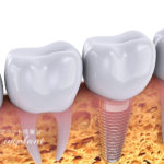 インプラントと骨の結合のメカニズム