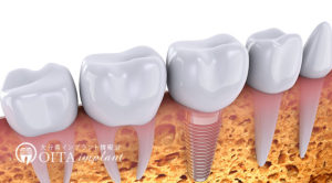 インプラントと骨の結合のメカニズム