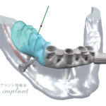 インプラントをより安全にするコンピューターガイドシステム