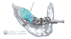 インプラントをより安全にするコンピューターガイドシステム