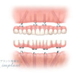 その日に噛める、即時荷重インプラントとは