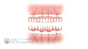 その日に噛める、即時荷重インプラントとは