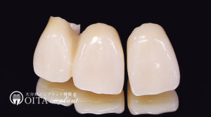 実際の「歯」として見える部分、インプラント上部構造