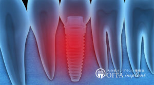 インプラントの歯周病、インプラント周囲炎とは