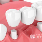 歯を失った後に選択するインプラントかブリッジ、どちらがいい？