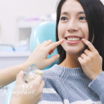 インプラント治療後のメンテナンス