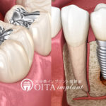 金属アレルギーの人はインプラントや銀歯は大丈夫？